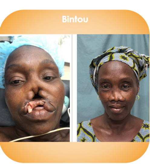 Patient avant et après intervention