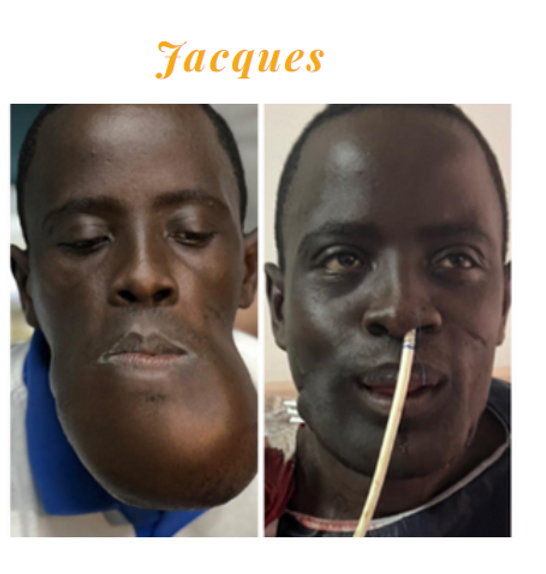 Patient avant et après intervention